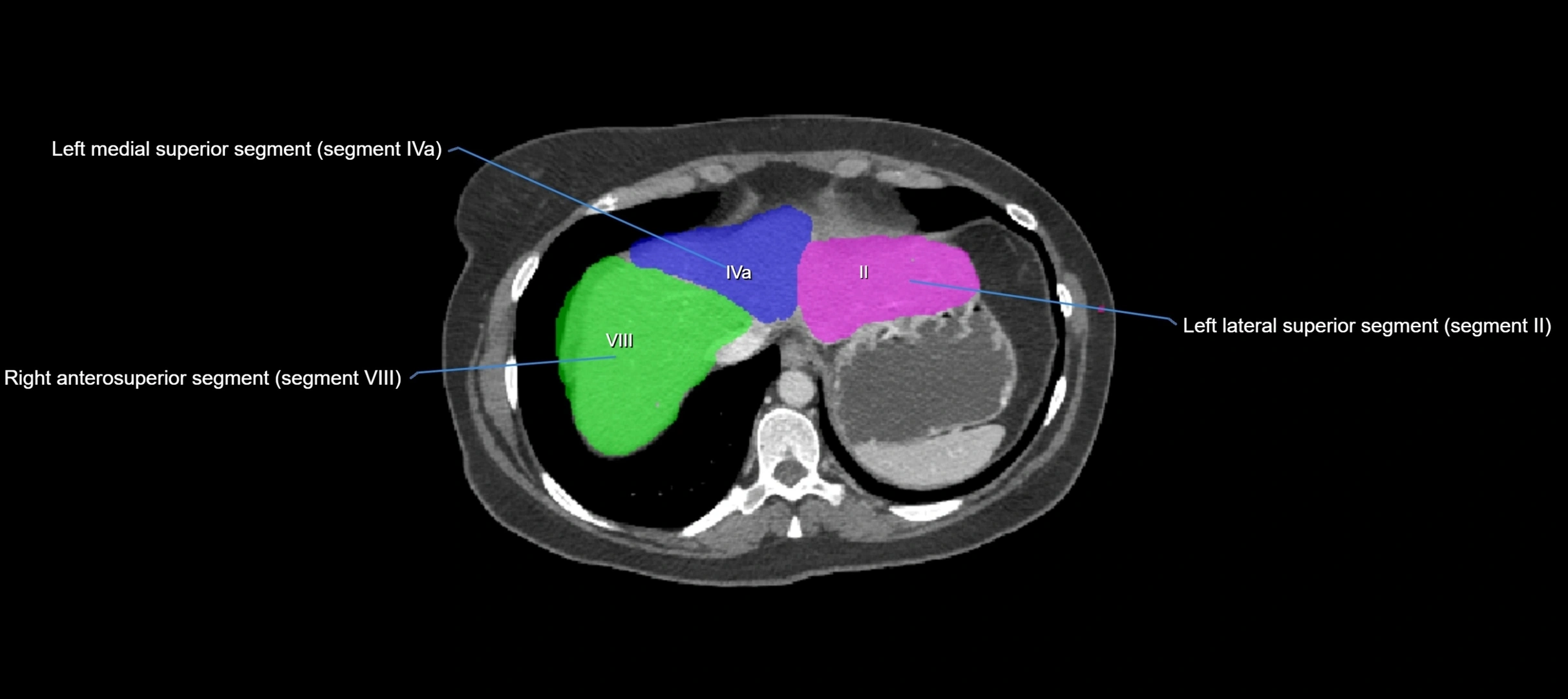CT liver segments axial cross sectional anatomy labelled image-00069.webp